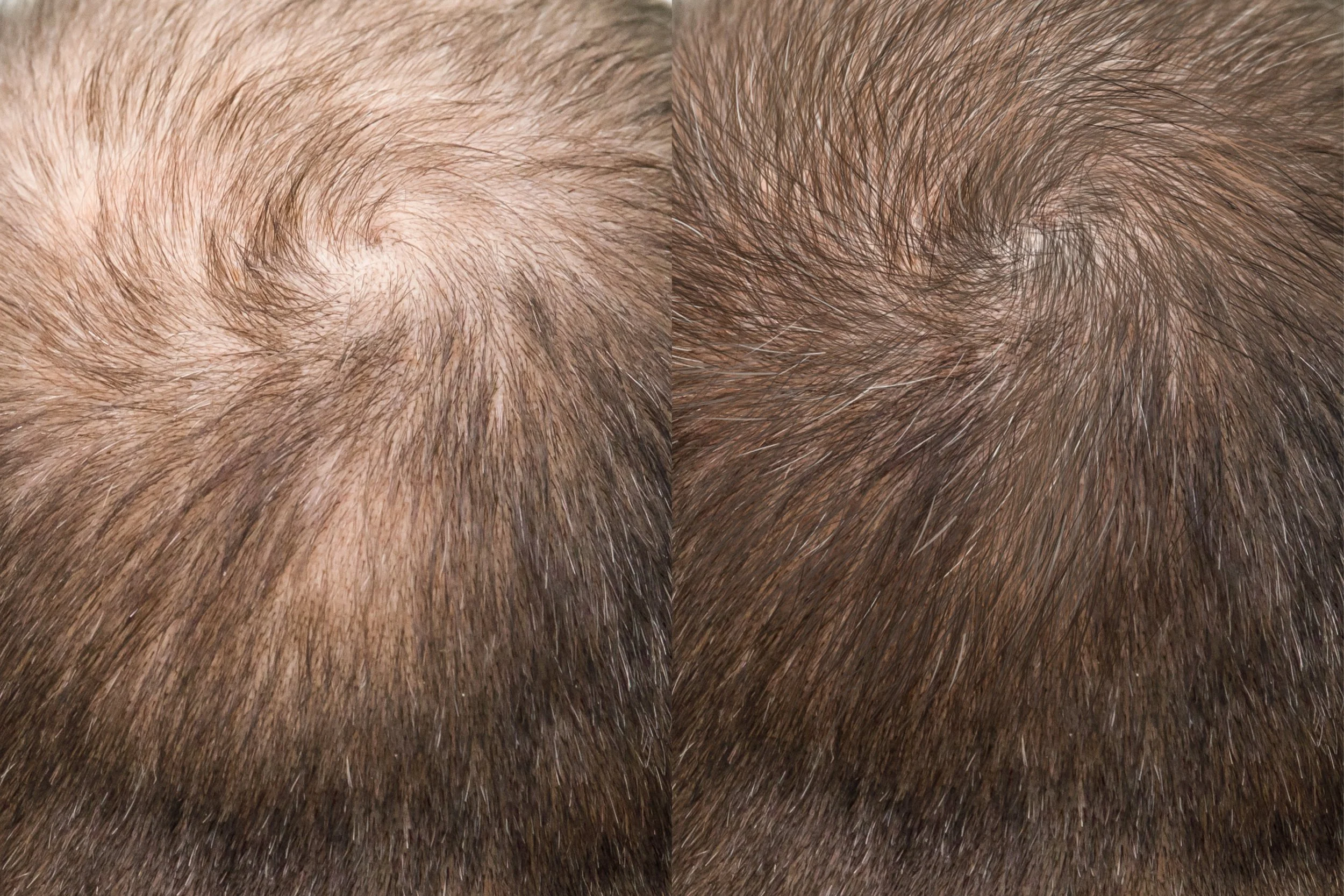 treatment of hair loss and baldness using mesotherapy for hair.jpg
