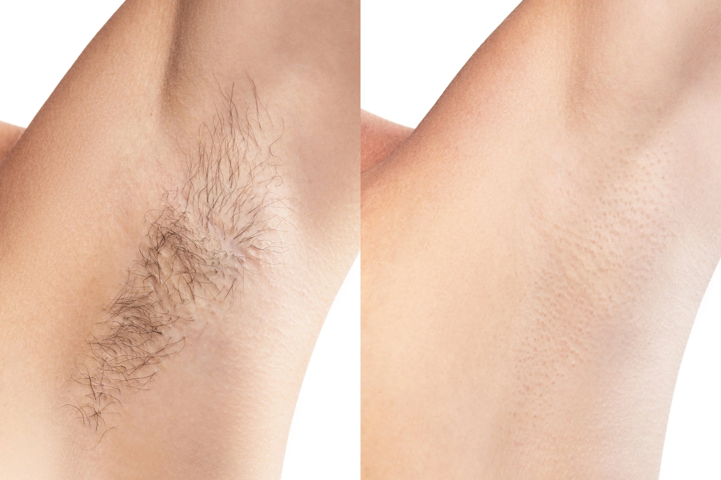before-after laser epilation of armpits in Awareness Beauty Clinic.jpg