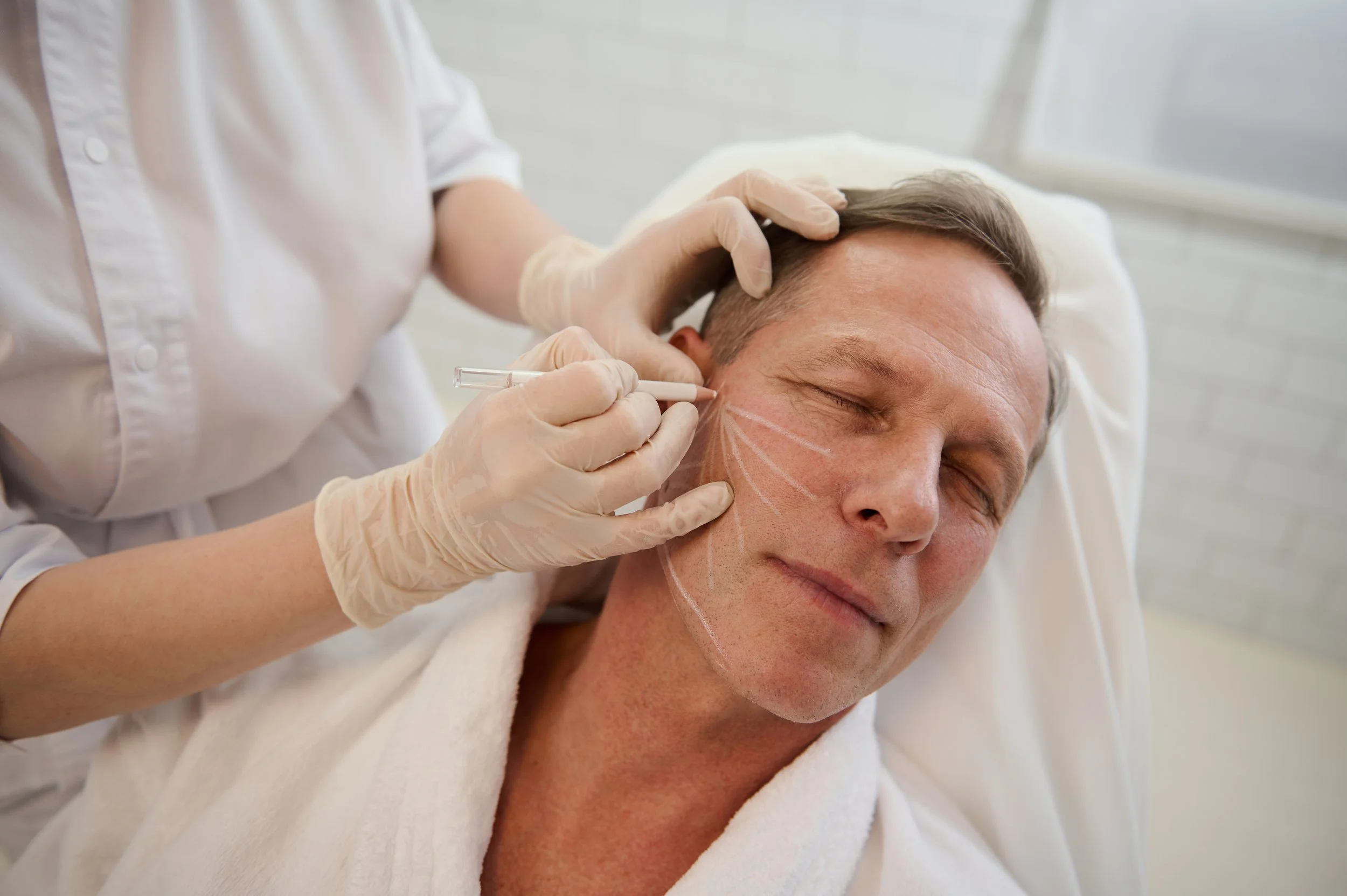 HIFU behandeling wangen bij mannen voor huidverstrakking en anti-aging