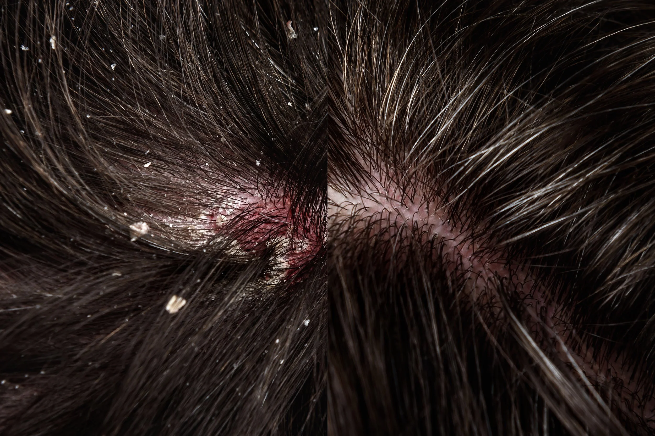 treatment of dandruff using hair mesotherapy.jpg