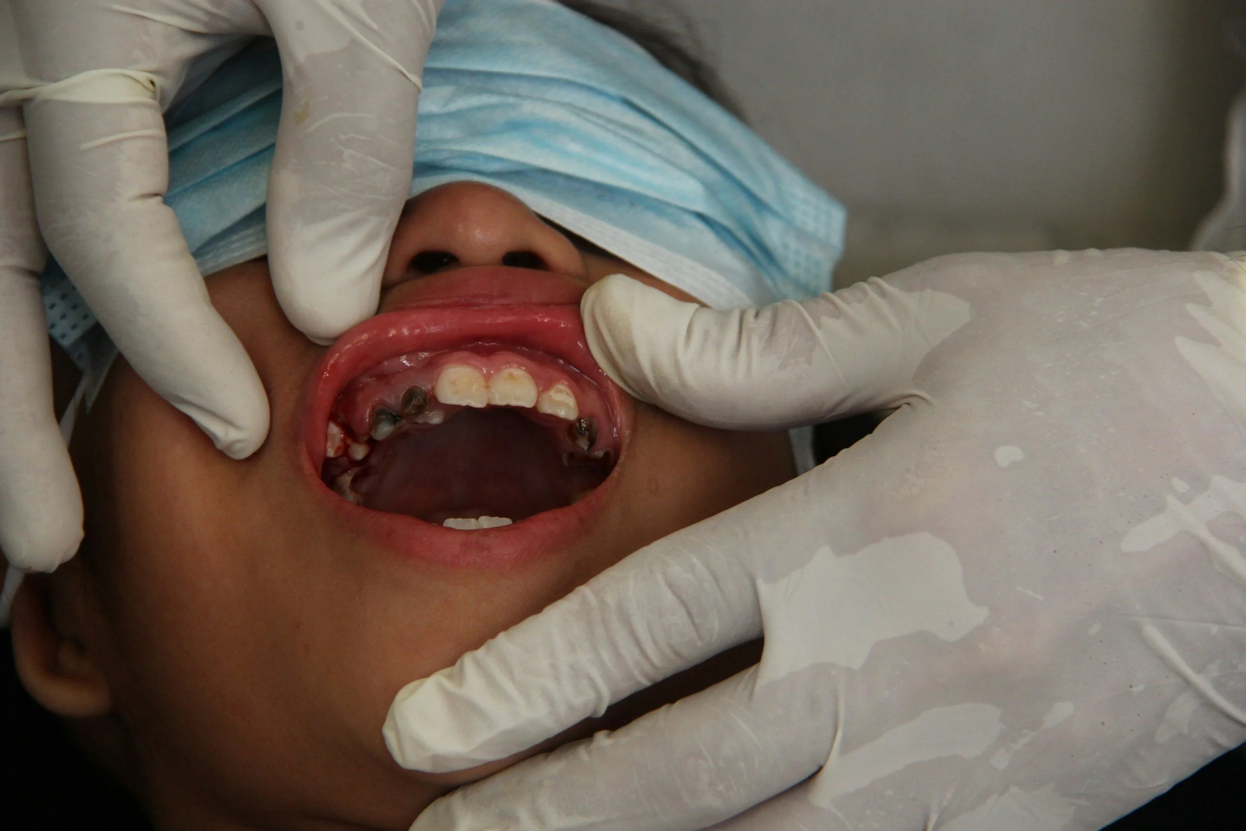 Danger in Disguise: How to Recognize and Treat Dental Abscesses in Kids