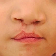 Understanding Cleft Lip &amp; Cleft Palate: How Kids Dentistry in Paradise Valley, AZ Supports Growing Smiles