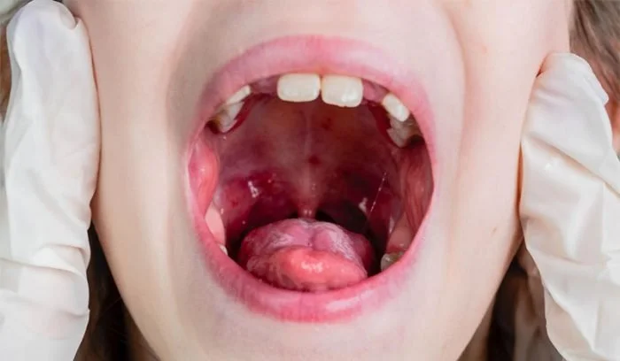 Why Is My Child’s Uvula Swollen? A Kids Dentistry Guide for Parents in Paradise Valley, AZ