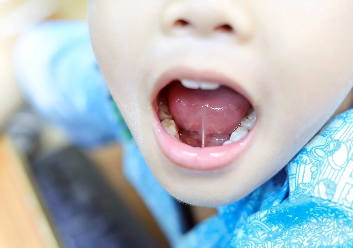 What Is a Tongue Tie and How Can It Affect Your Child’s Oral Health?