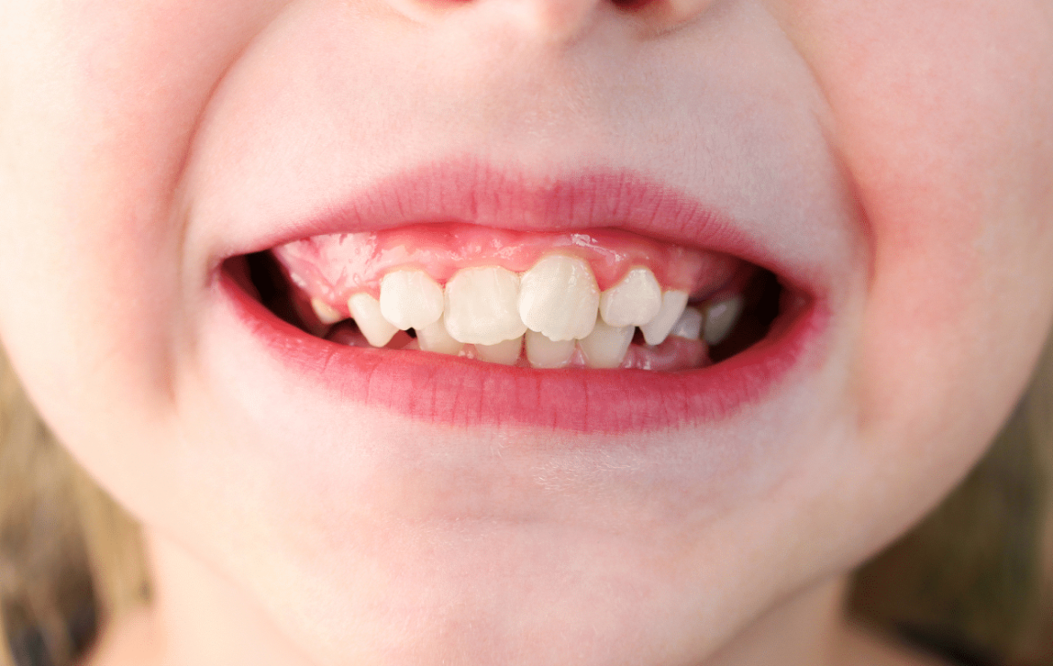 Teeth Growing Together? Early Signs of Crowding and How Kids Dentistry Can Help