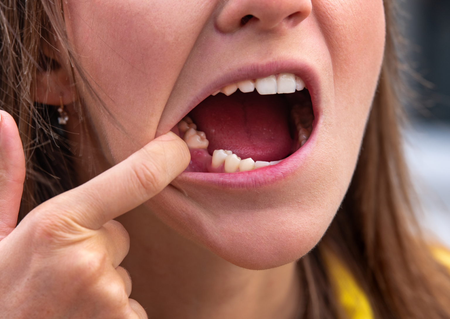 Why Did My Child Lose Multiple Molars So Close Together? A Pediatric Dentist Explains