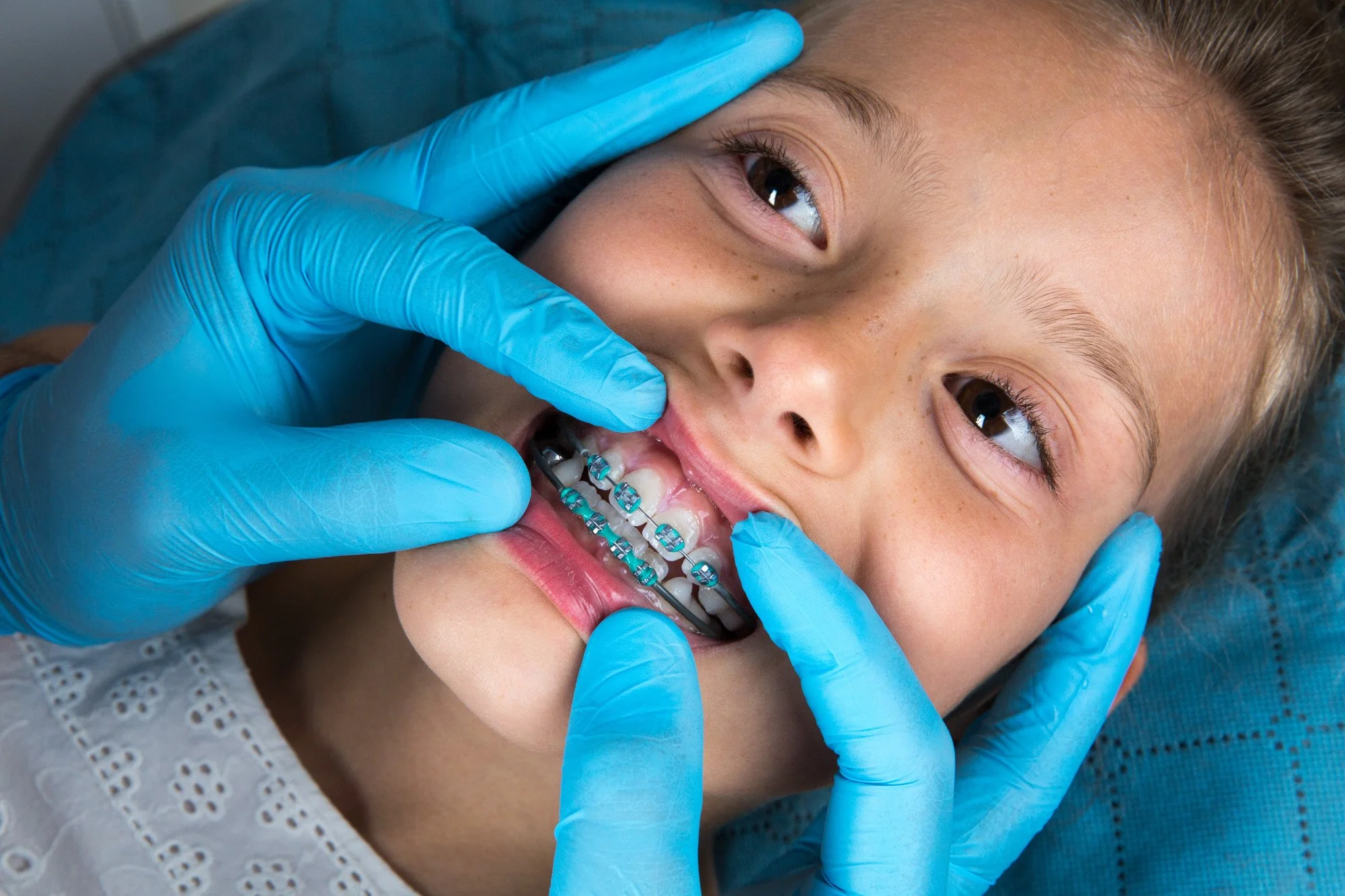What Is the Best Age for Braces? A Pediatric Dentist Explains