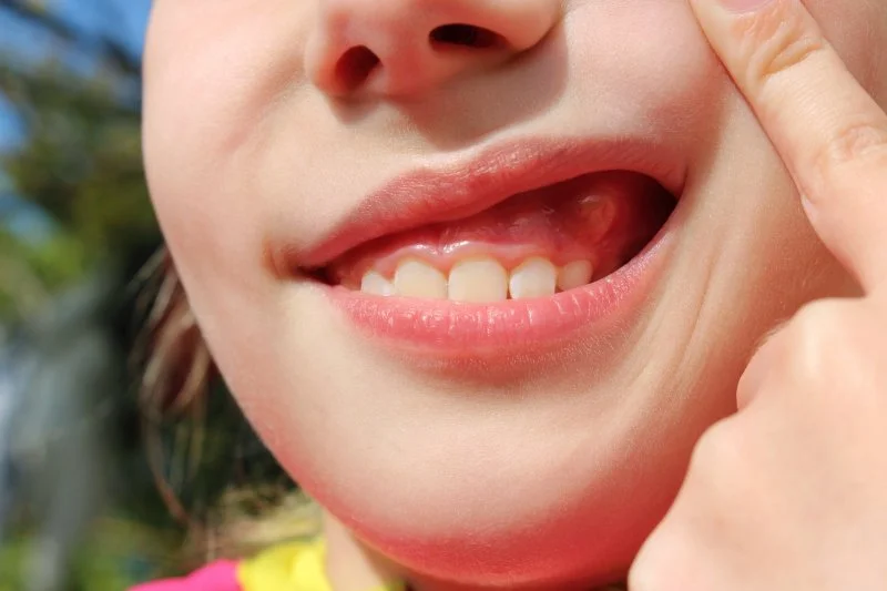 Swollen Gums in Kids: What’s Normal, What’s Not, and When to See a Dentist | Paradise Valley, AZ