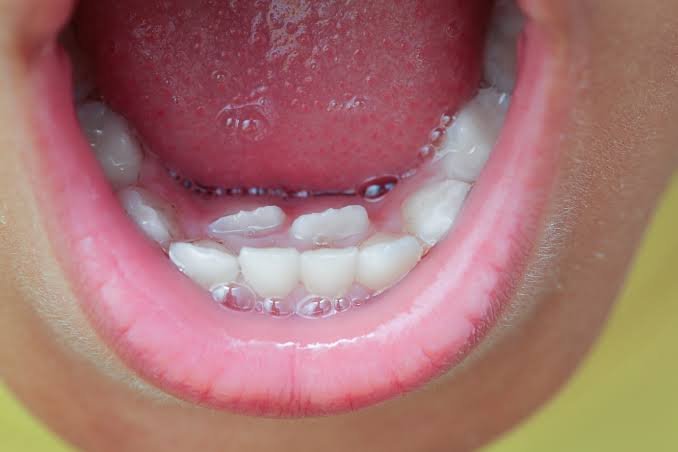 Why Does My Child Have “Double Teeth”? Understanding Double Rows of Teeth in Kids