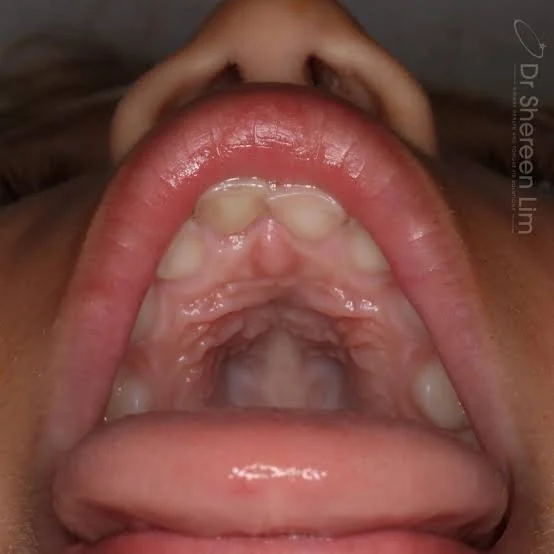 Is Your Child’s Palate Too Narrow? Signs Parents Should Know | Pediatric Dentist in Paradise Valley, AZ