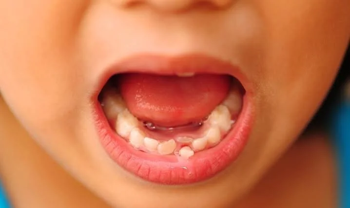 Your Child’s First Loose Tooth: What Parents Should Do (and What to Avoid)