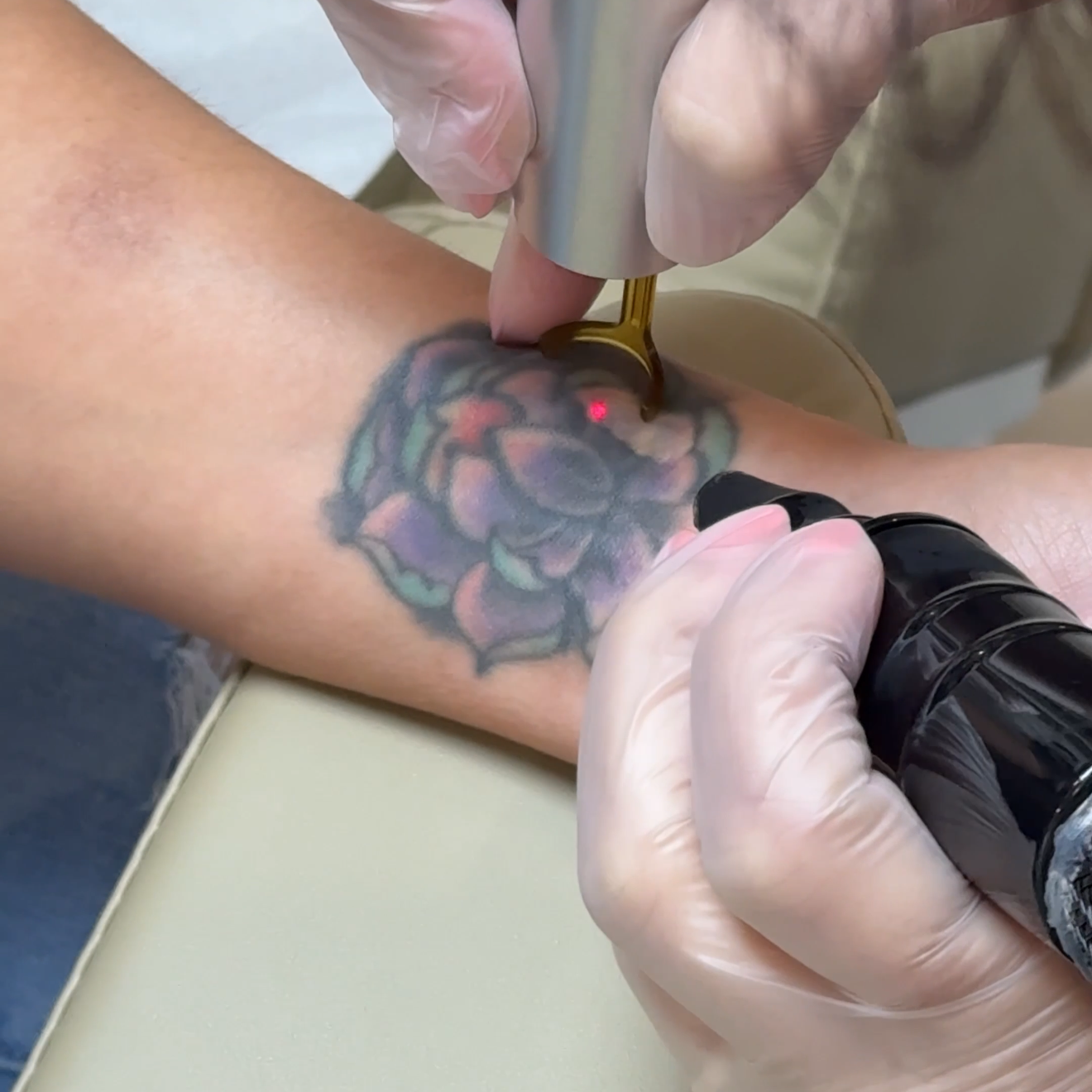 A person getting a tattoo removed on their forearm with a picoway machine from candela, with a colorful flower design visible.