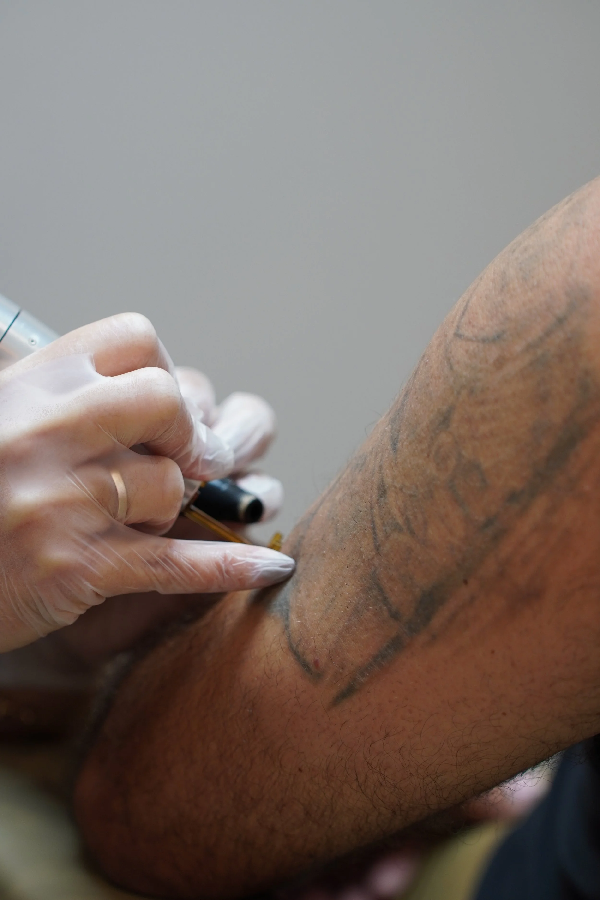 frosting of tattoo removal with picoway laser from candela 