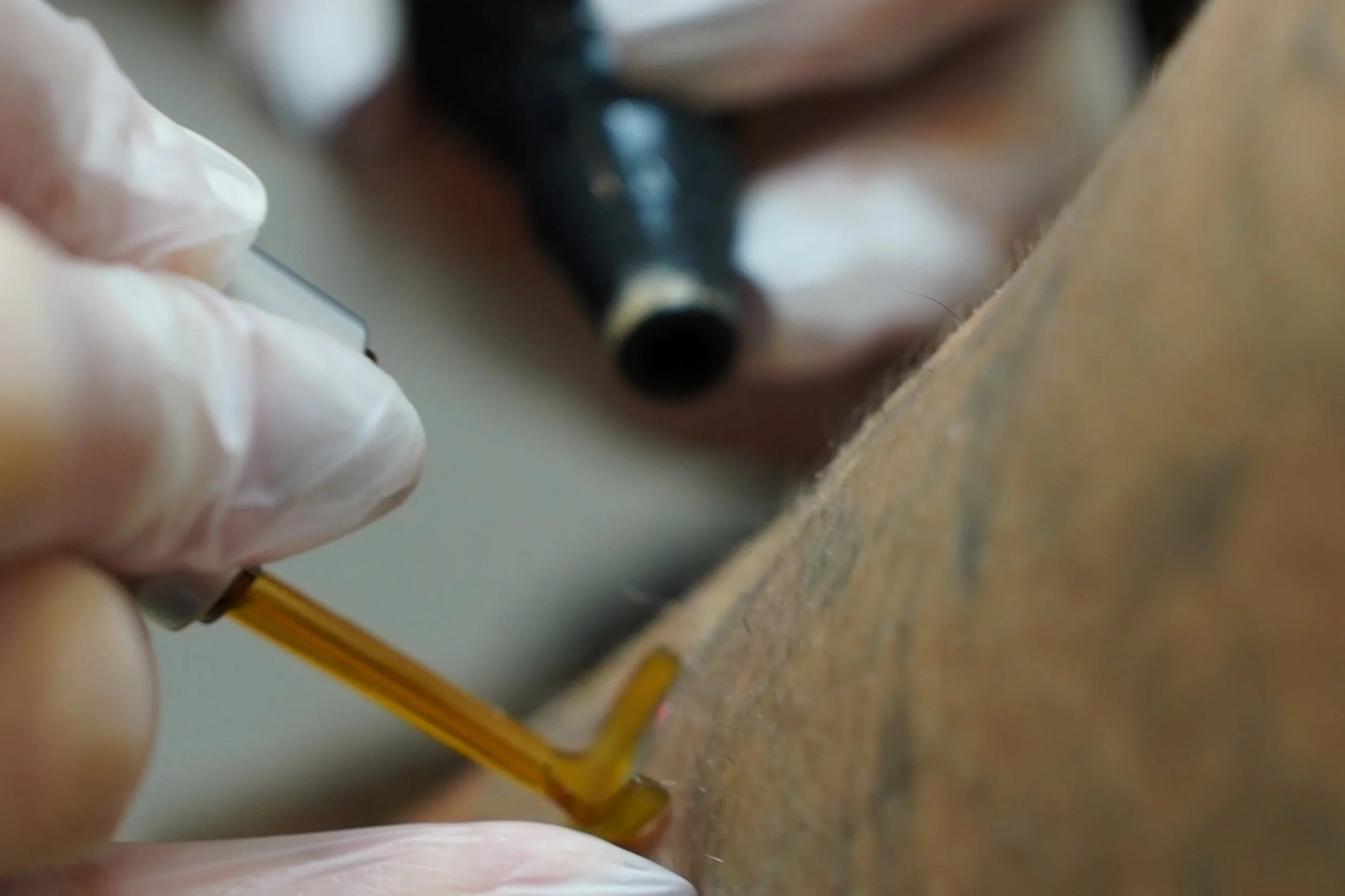 Close-up of tattoo removal process
