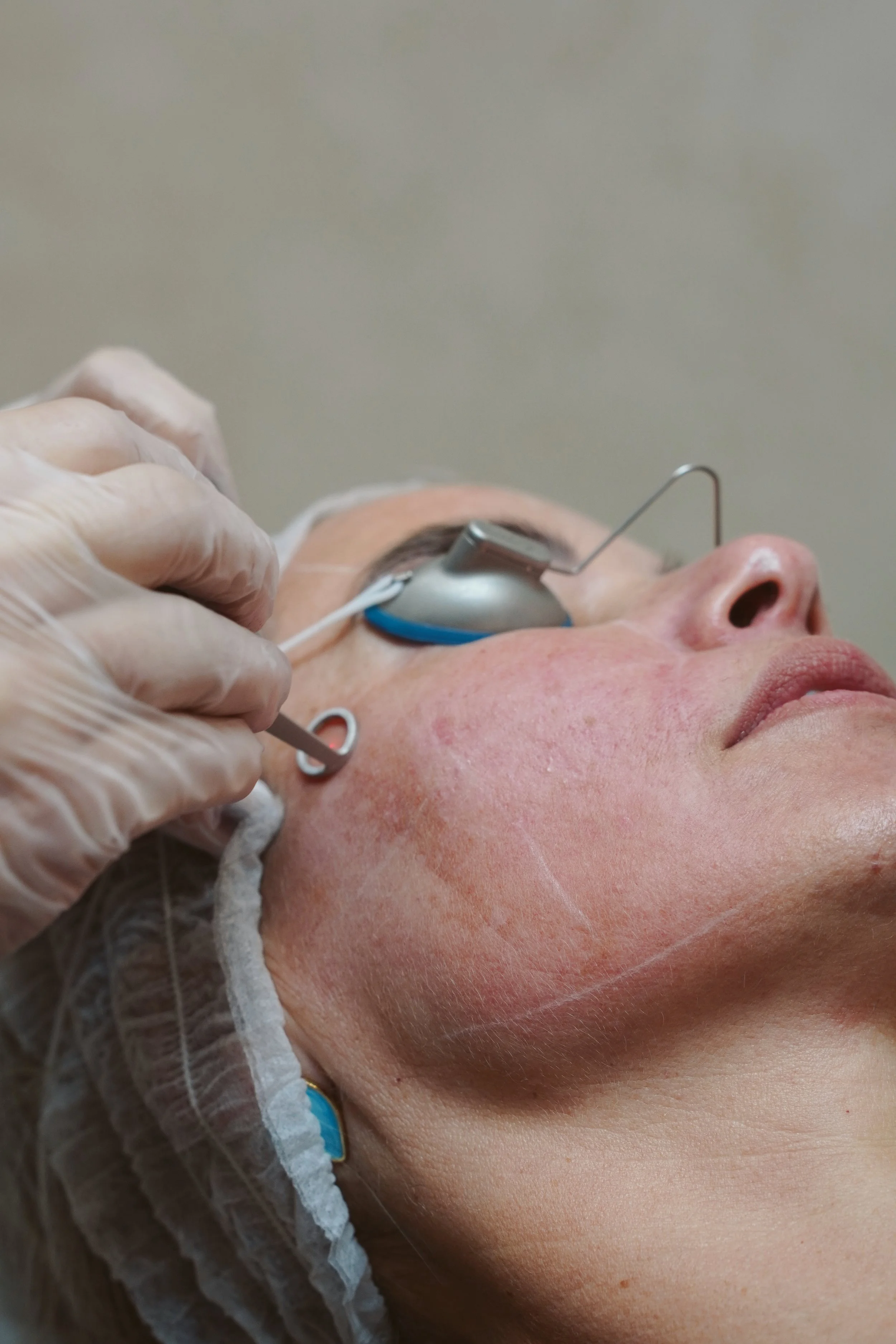 A person receiving skin rejuvenation procedure with picoway laser to remove pigmentation or large pores and skin texture from a healthcare professional wearing gloves.