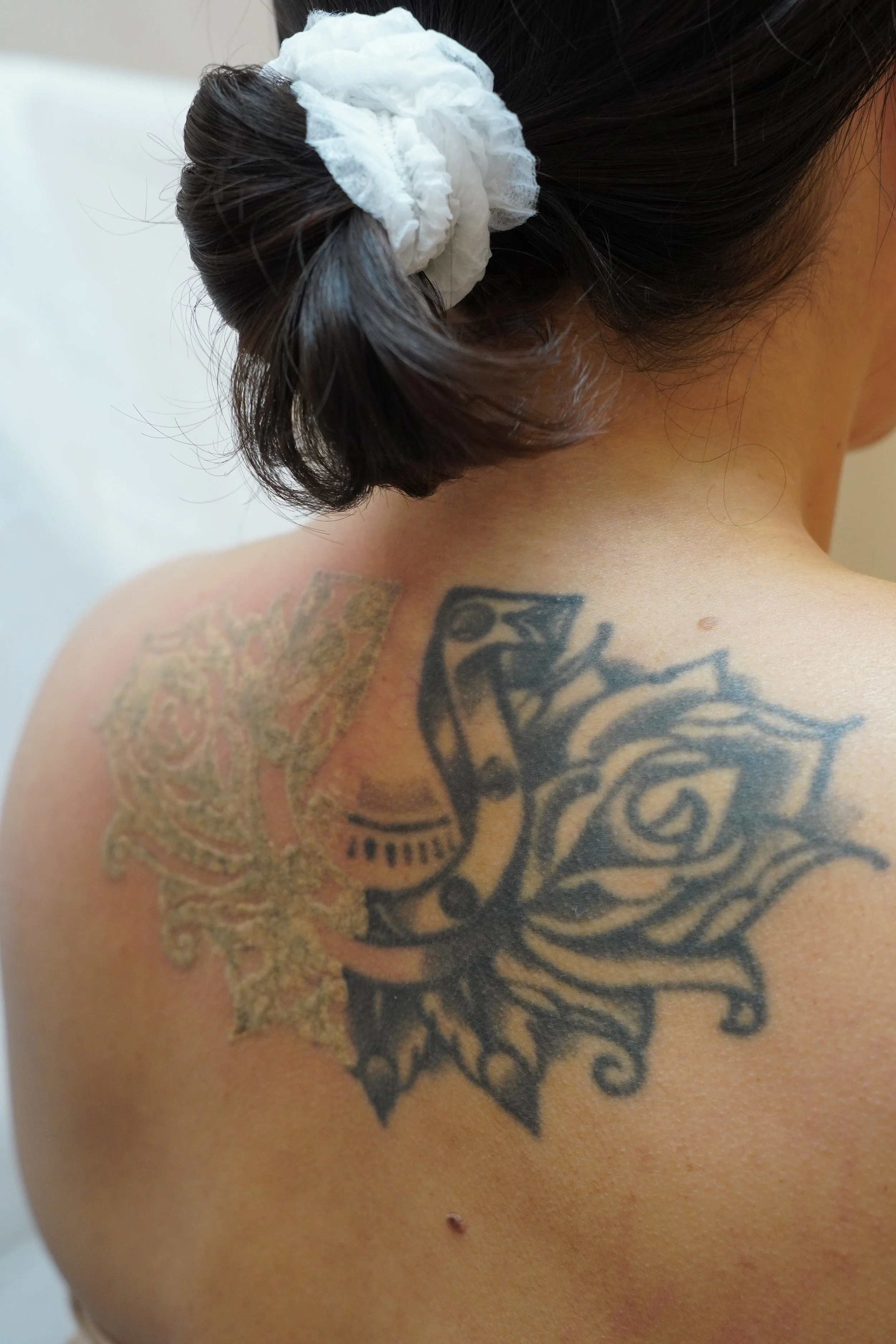 tattoo removal process mid way removal frosting effect with the picoway laser.