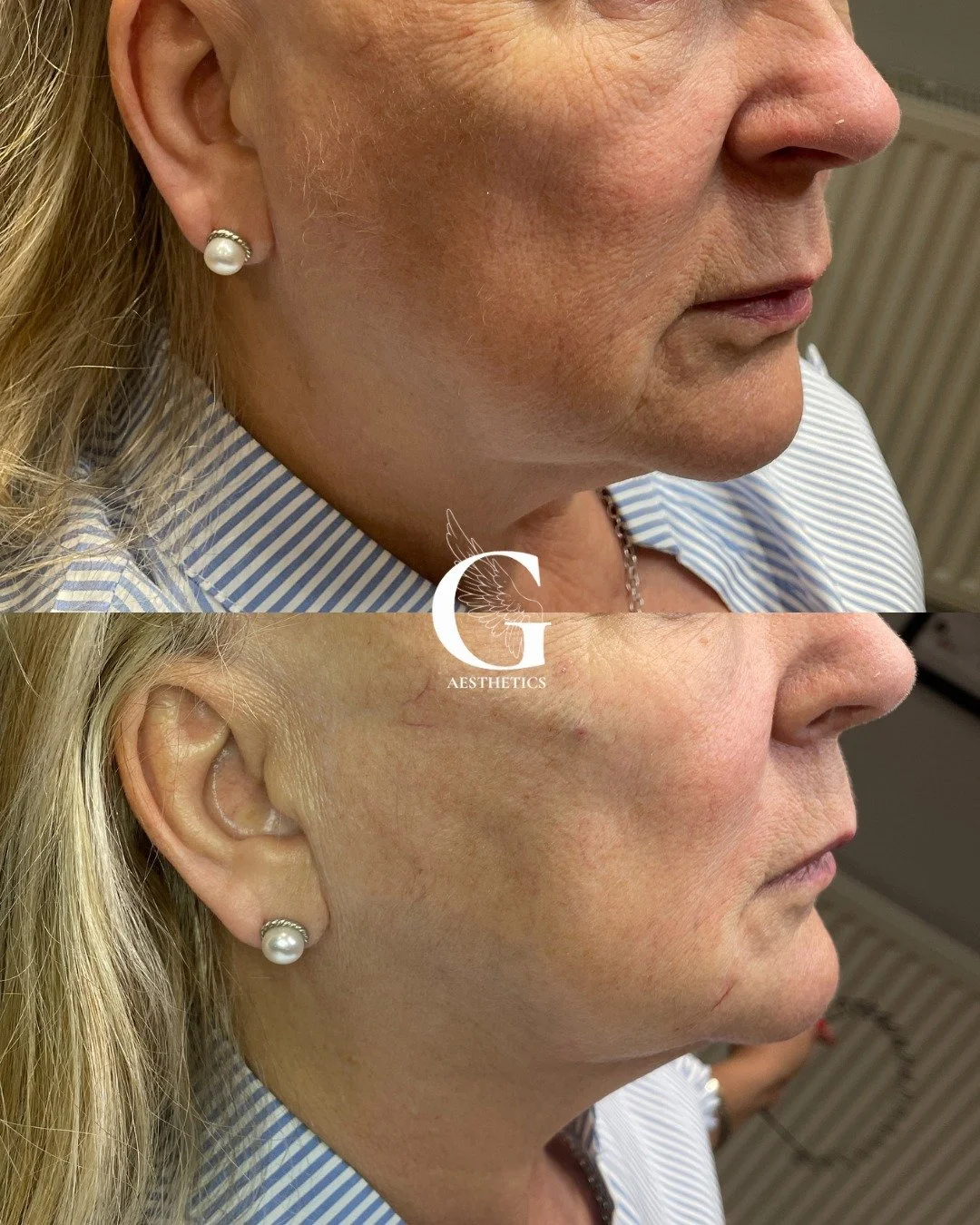 Look how much better the shadows around my client&rsquo;s face fall after just a little bit of filler. We lifted the cheeks, softened the under eyes, and brought back youthful structure.

Book an appointment with me using the link in bio!
