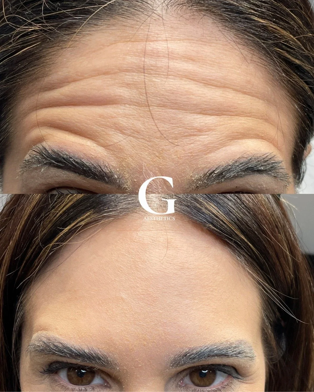 Anti wrinkle injections gently relax the muscles that cause wrinkles and prevent deeper lines from forming and ageing you further!

Send me a message or book an appointment or a consultation using the link in bio.