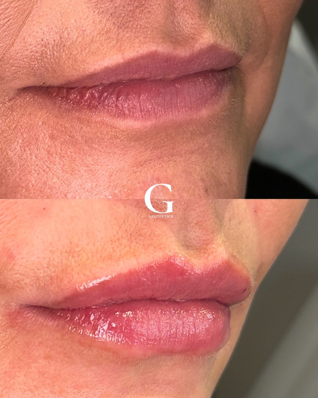 It may be the New Year, but these lips from last year are still one of my favourites! Lip filler isn&rsquo;t just for having &ldquo;big lips&rdquo; , it&rsquo;s for simply hydration and slight plumping also. 

Book your appointment with me using the 