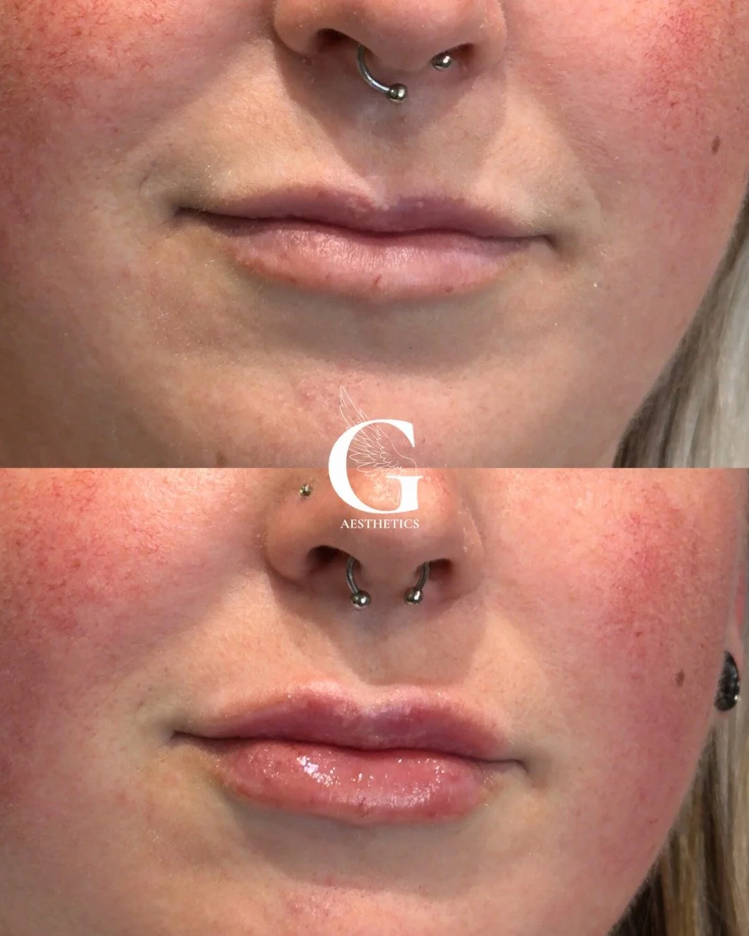 A little lip filler added for symmetry and balance. 💉 Book your lip filler appointment with me using the link in my profile.