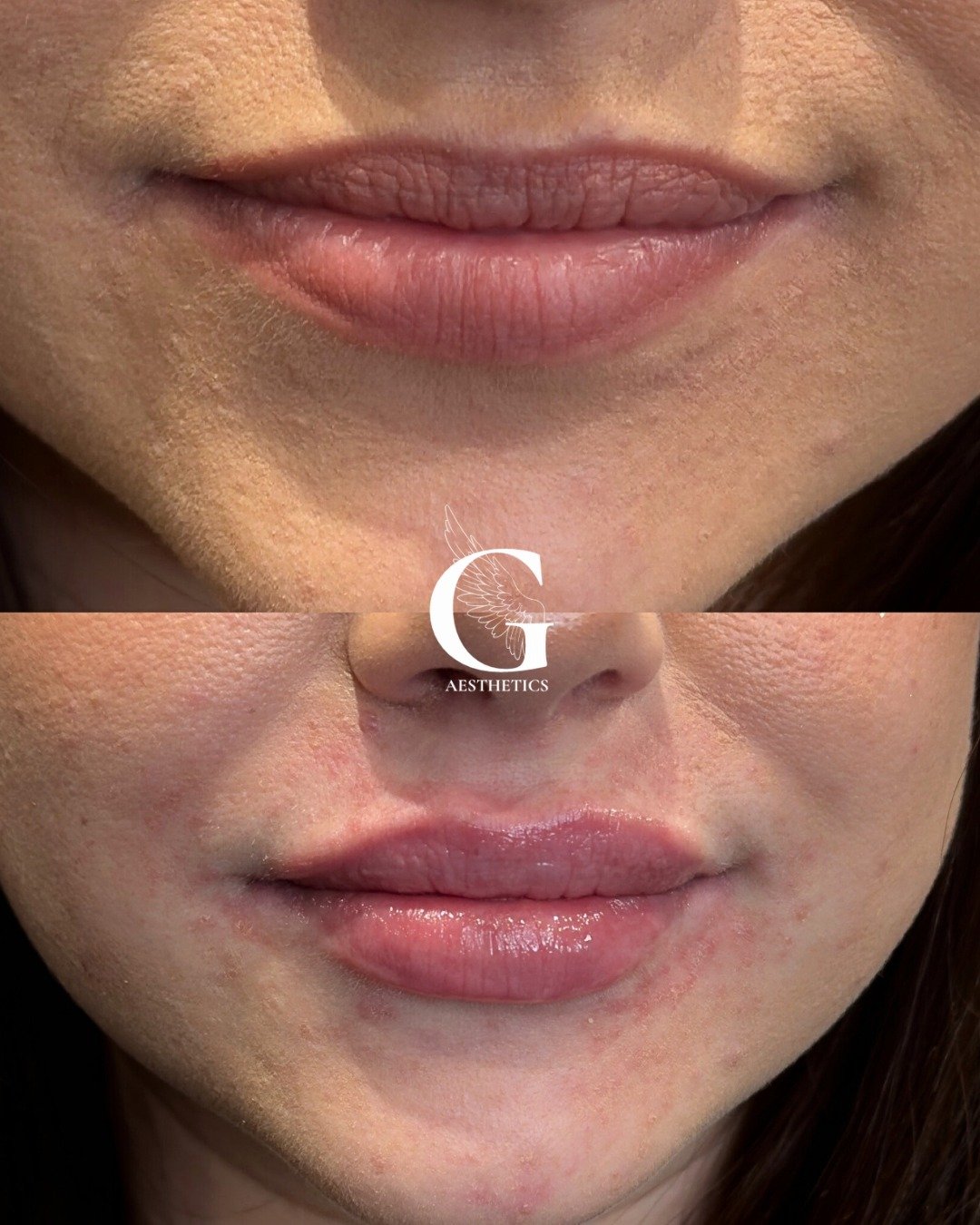 Just a tiny touch of lip filler and you can see straight away how much more hydrated her top lip looks. The little fine lines are gone instantly. 

Interested? Book a consultation via the link in my profile.