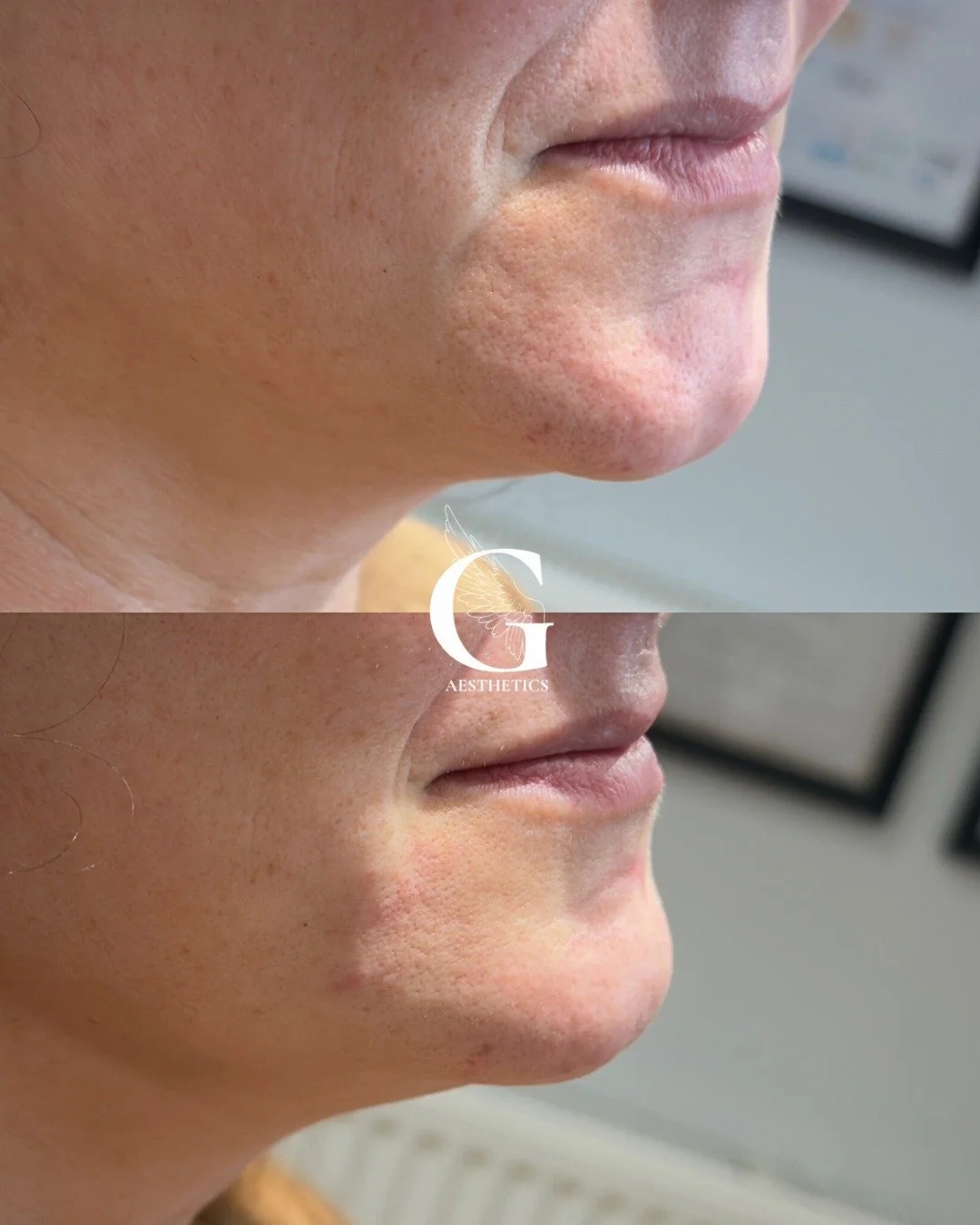 Chin filler is one of those treatments that just completely transform your side profile and your facial balance.

If your chin feels recessed or you have a round face- chin filler is an instant transformation that gives you that balance you&rsquo;ve 