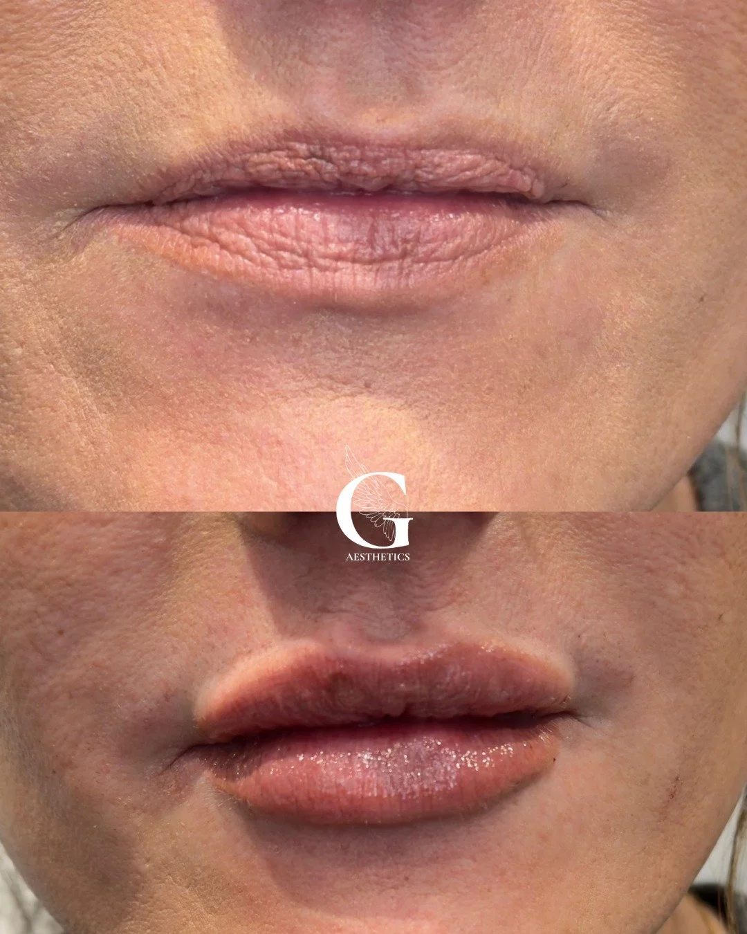 One for the lip filler fans&hellip;

These photos were taken immediately after treatment, so the swelling you can see is temporary.

Look closely at the improvement in her lip lines&hellip; Less creasing, softer lip lines and hydration. Love it!

Lin