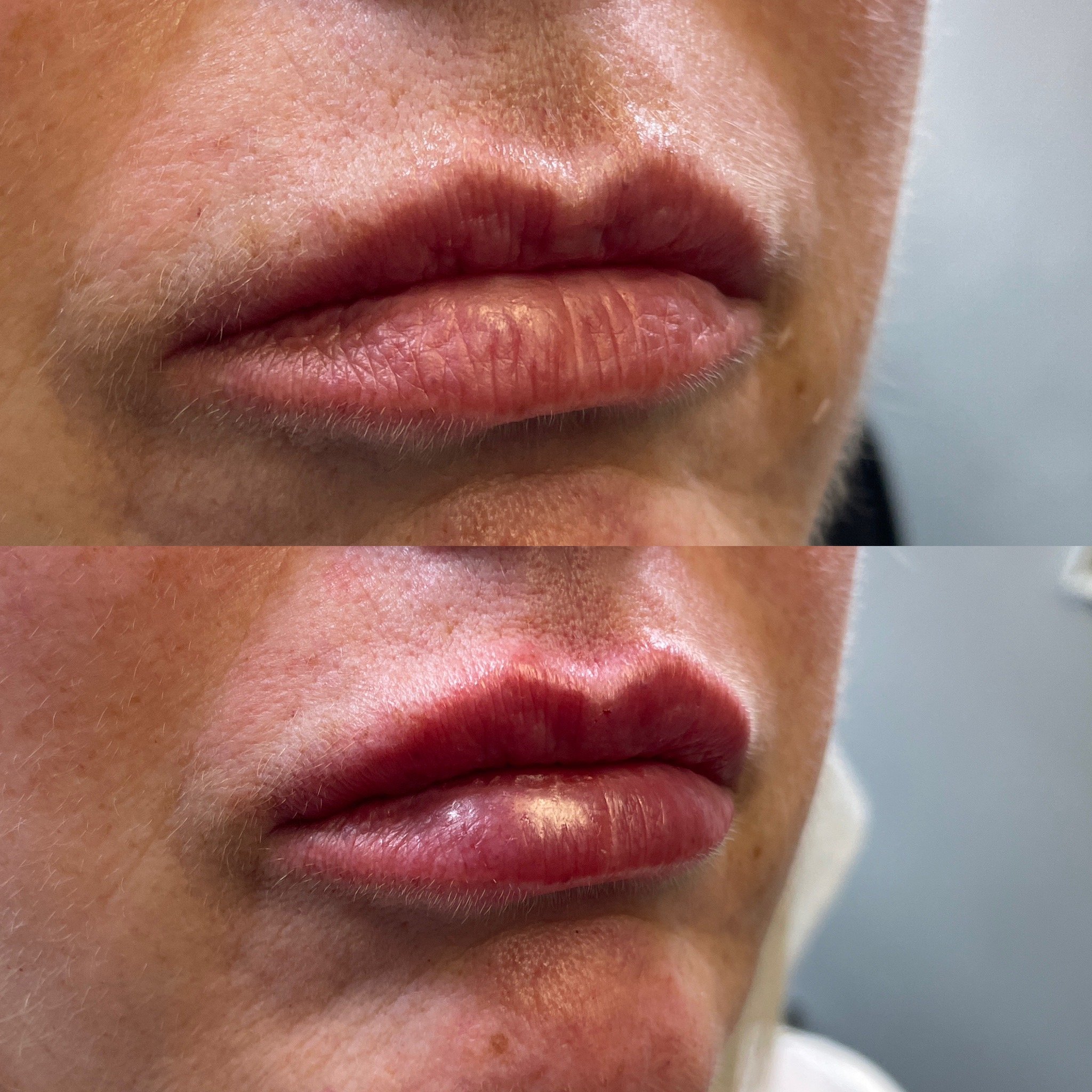 Lip filler before and after