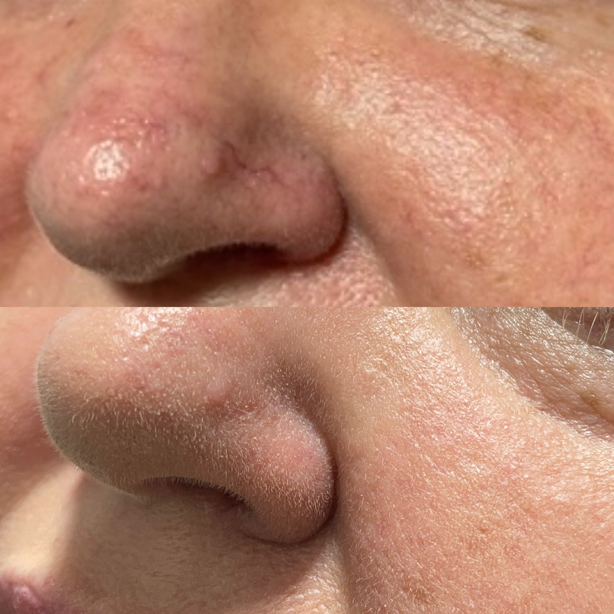 Sclerotherapy before and after