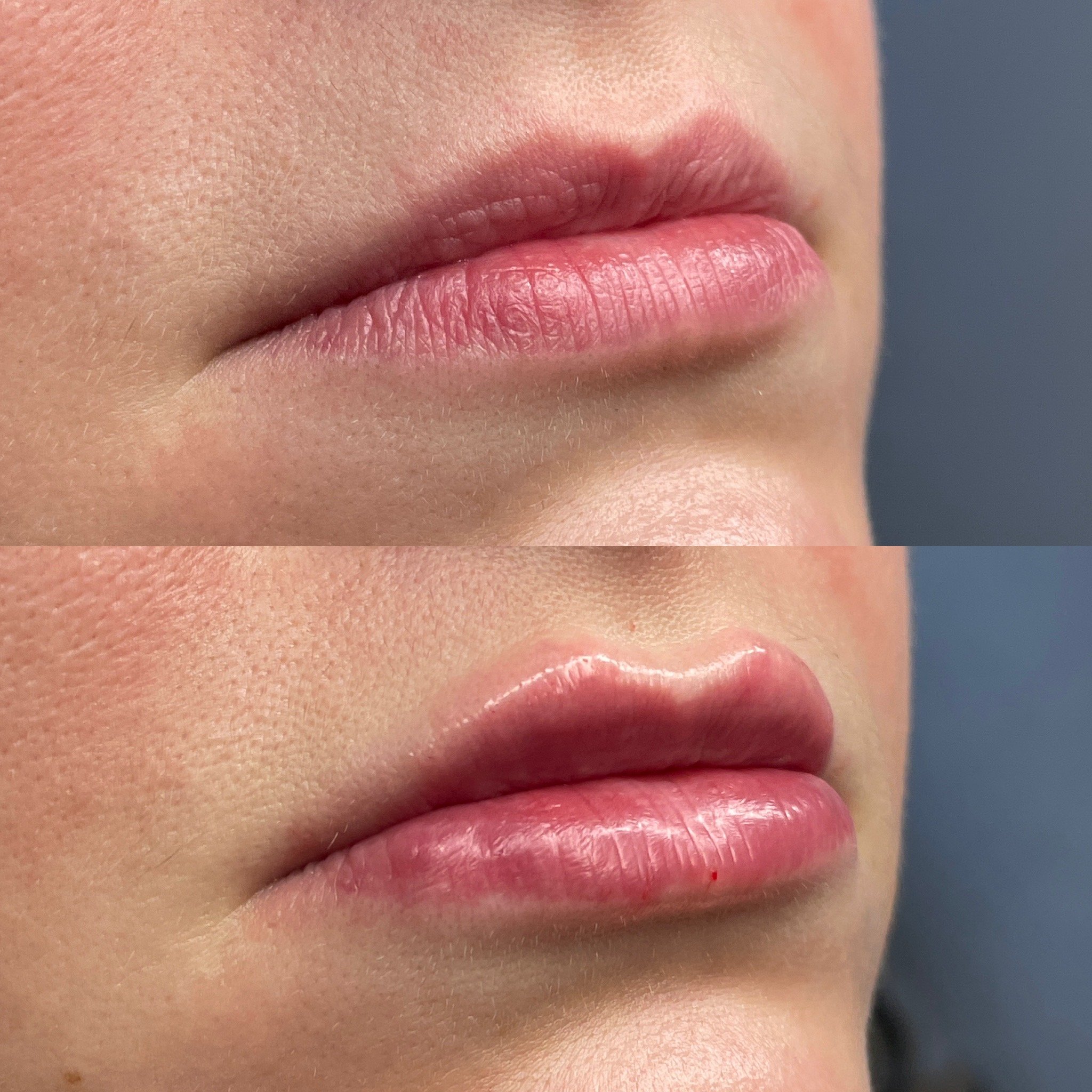 Lip filler before and after