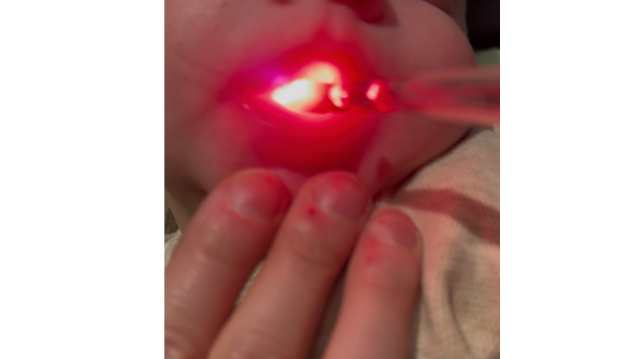 How SLPs Can Use Laser Therapy Before and After Tongue Tie Release