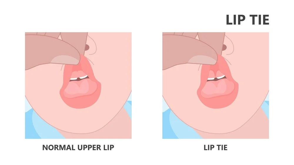 Lip Tie in Babies: Signs, Symptoms and What to Do