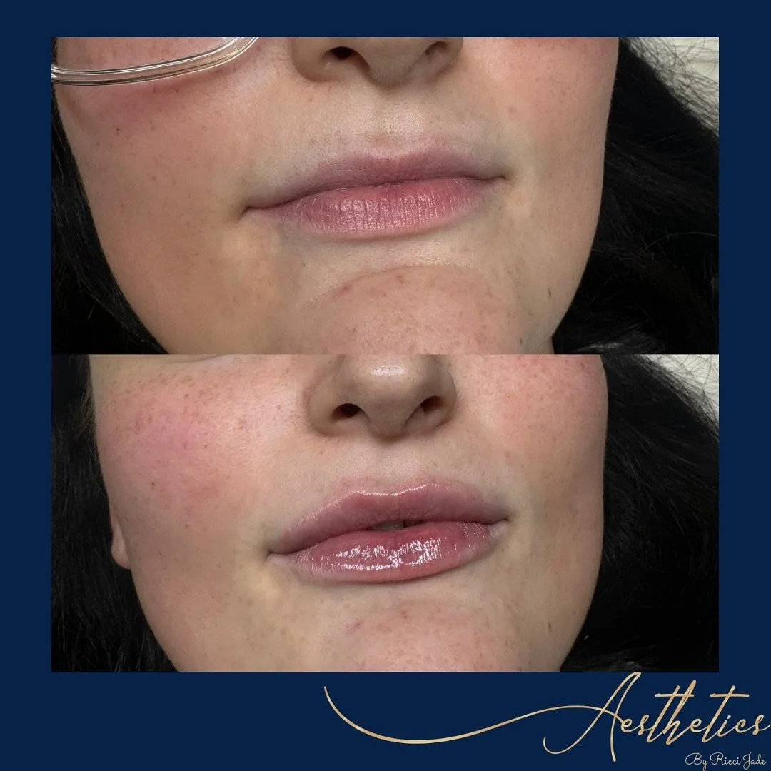 ✨Lip Filler✨

How subtle are these 😍 my client wanted really natural looking filler just to add some symmetry, definition and volume to the top lip. We used 0.7mls to achieve this ✨

Link to book in bio 💙
Norwich | Dereham

#LipFiller #NaturalLooki