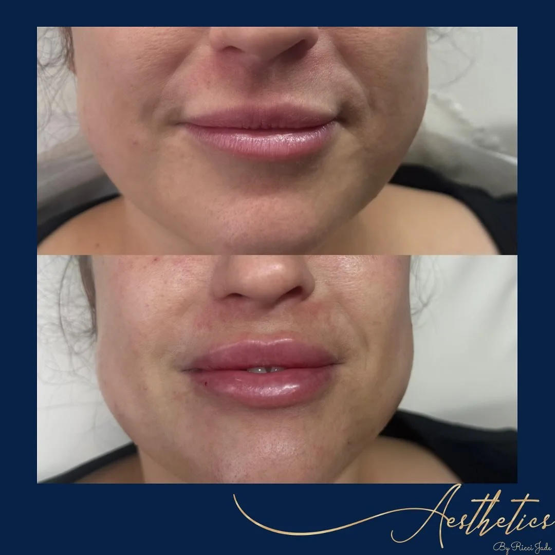 ✨Lip Filler✨

LOVE these lip filler results from the weekend. We used 1ml of dermal filler to correct symmetry, increase volume and define the cupids bow 😍

Link in bio to book 👄 

#lipfiller #aestheticsorfolk #norwichaesthetics #dermalfiller #lipf