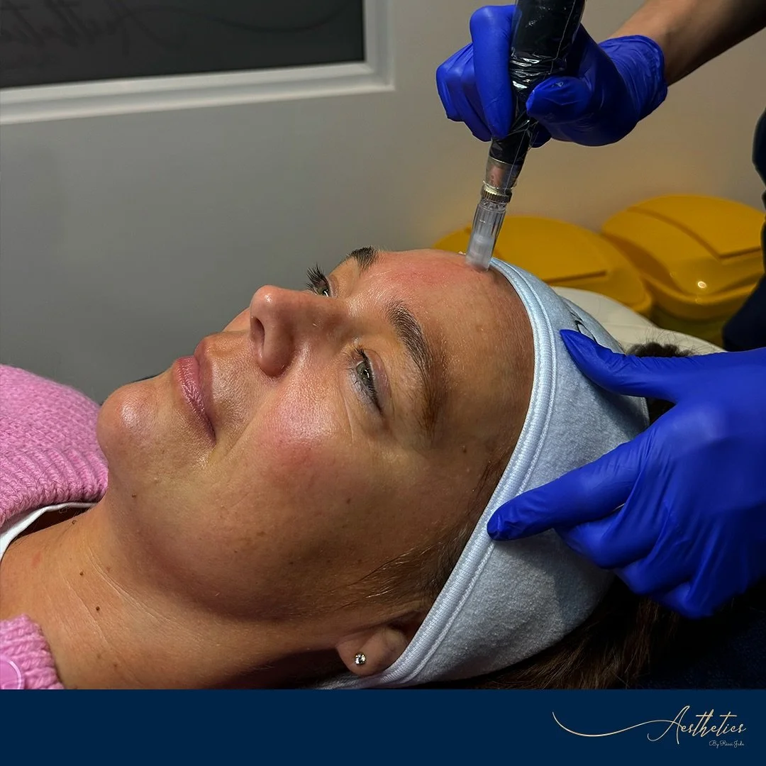 Revitalise your skin with our Microneedling treatments, available for both the face and neck! ✨

Microneedling stimulates collagen production, helping to reduce fine lines, acne scars, and improve overall skin texture. We also offer PRP treatments fo