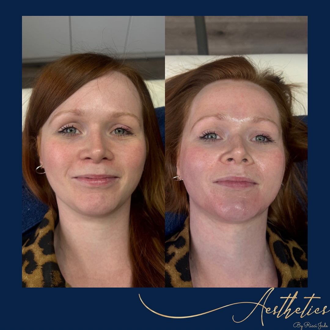 ✨MICRONEEDLING✨

Just look at the before and instant after pictures of this Microneedling treatment 😍 that GLOW 🌟
 

Microneedling is the ultimate skin-boosting treatment&hellip; This minimally invasive procedure uses tiny needles to create micro-i