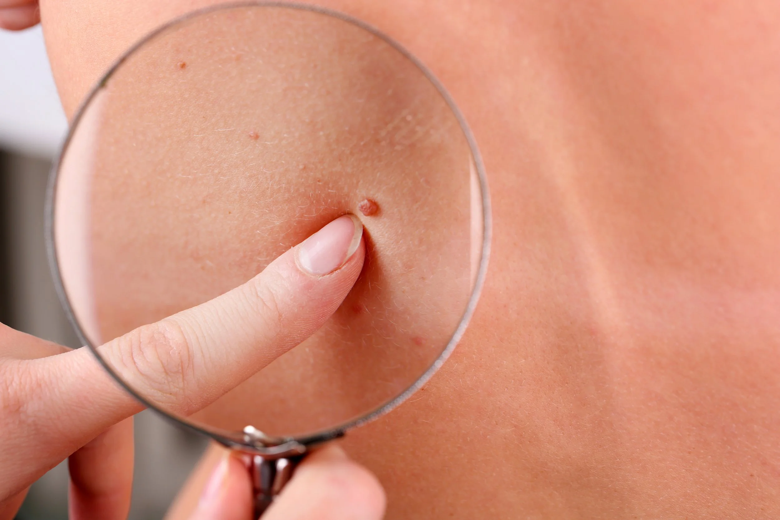Surviving Skin Cancer: Lessons from Real-World Evidence