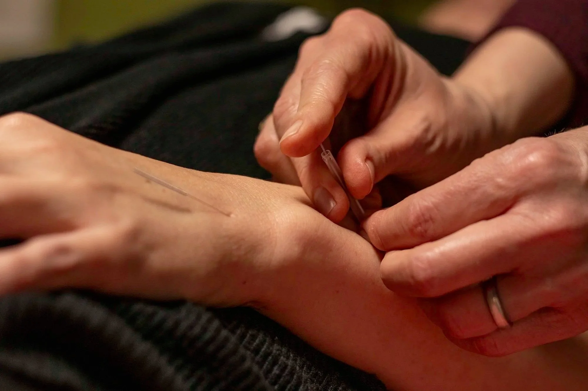 A person inserting an acupuncture needle into another person's wrist