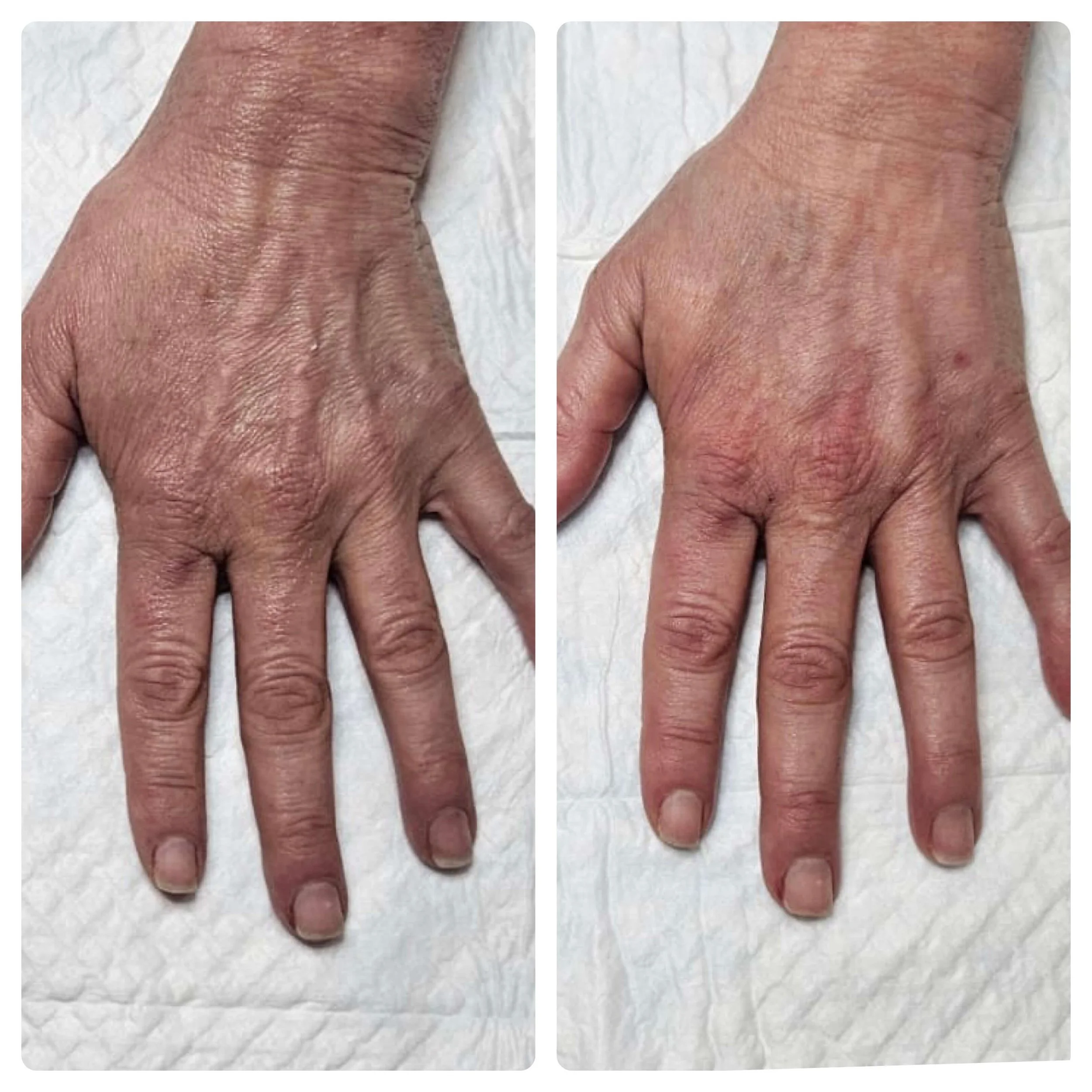 B-FAB® Skin Booster & Dermal Filler