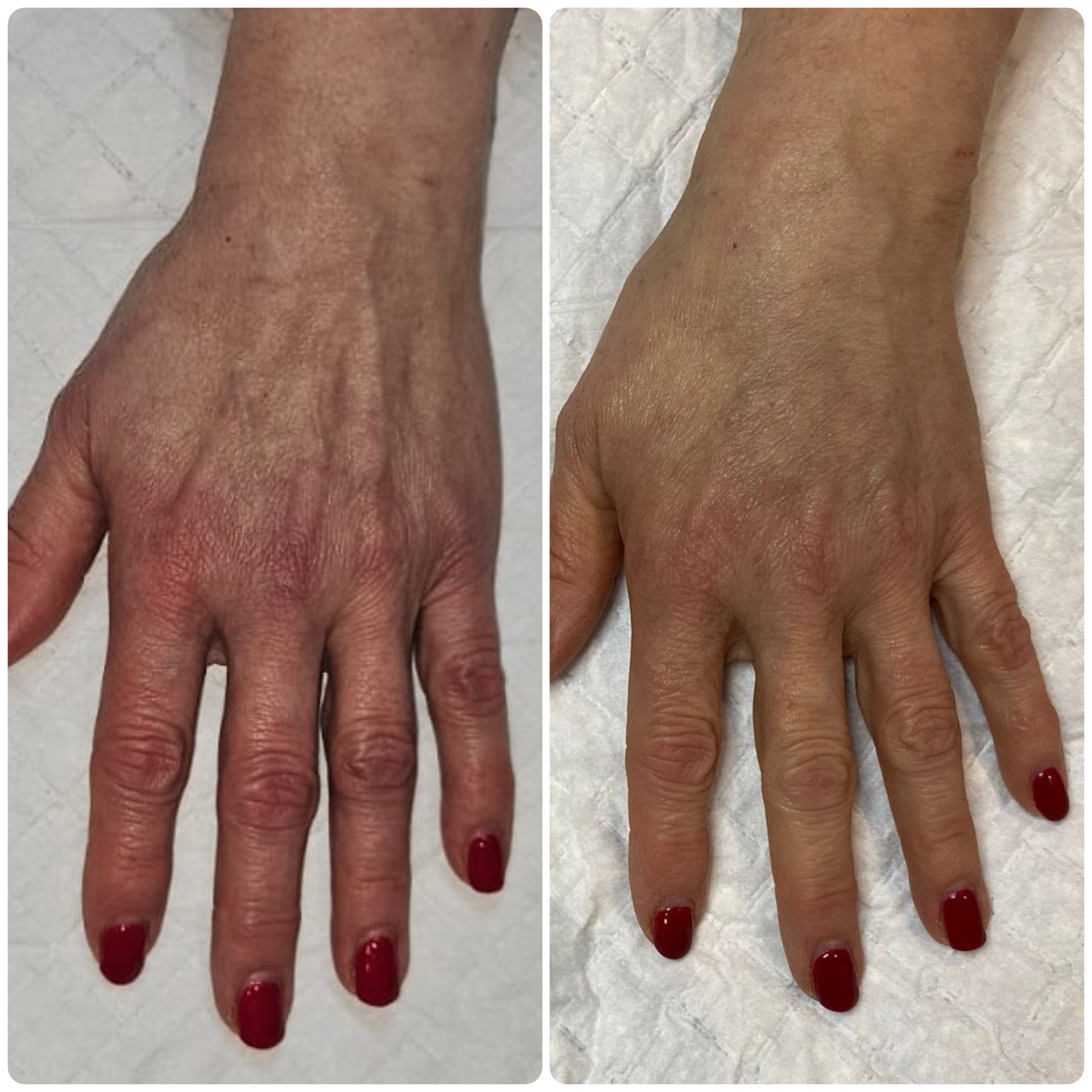 B-FAB® Skin Booster & Dermal Filler