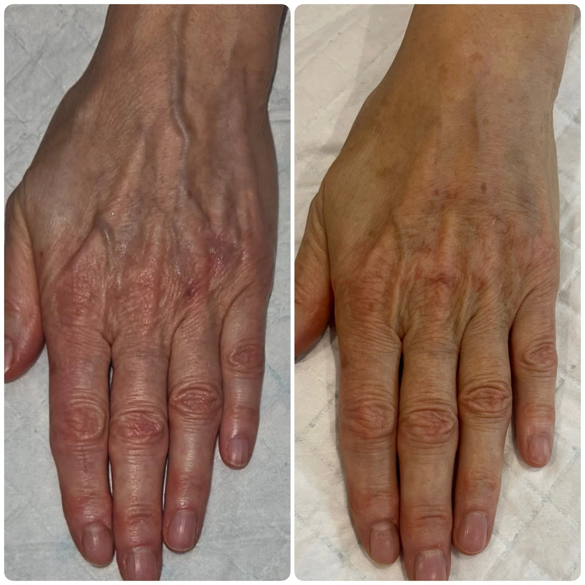 B-FAB® Skin Booster & Dermal Filler