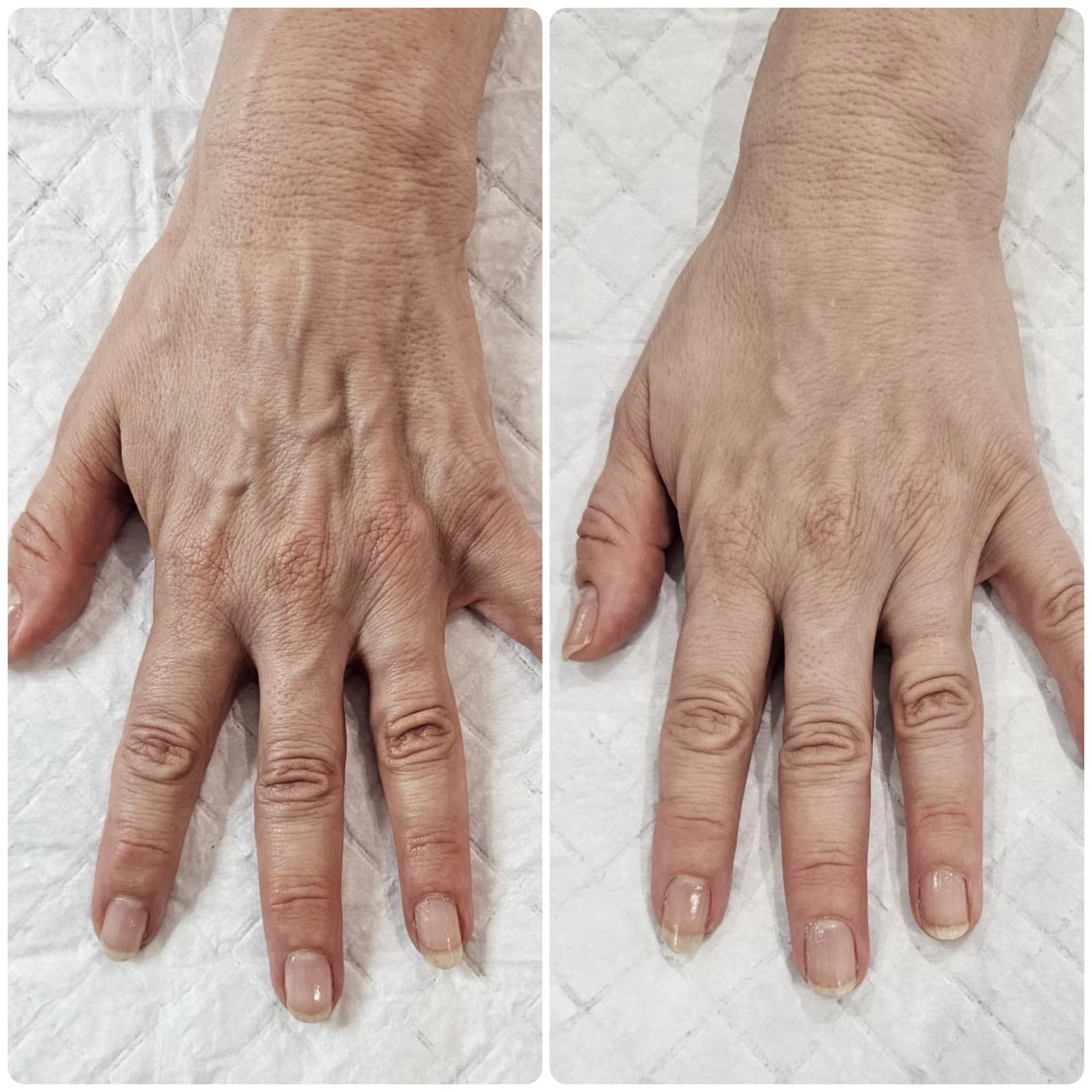 B-FAB® Skin Booster & Dermal Filler