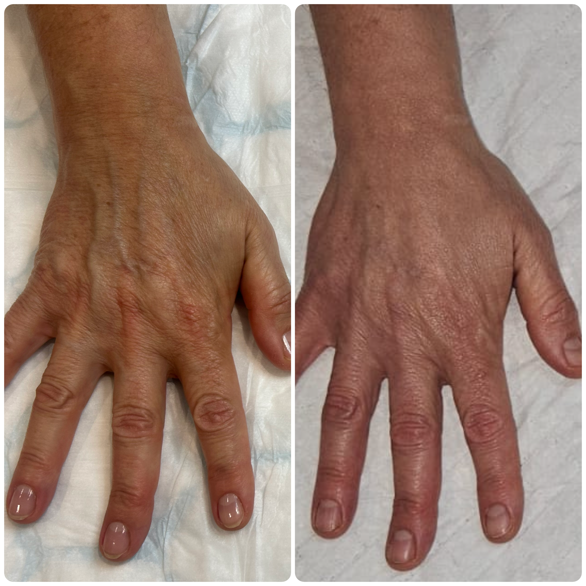 B-PAB®  Skin Boosters & Polynucleotides