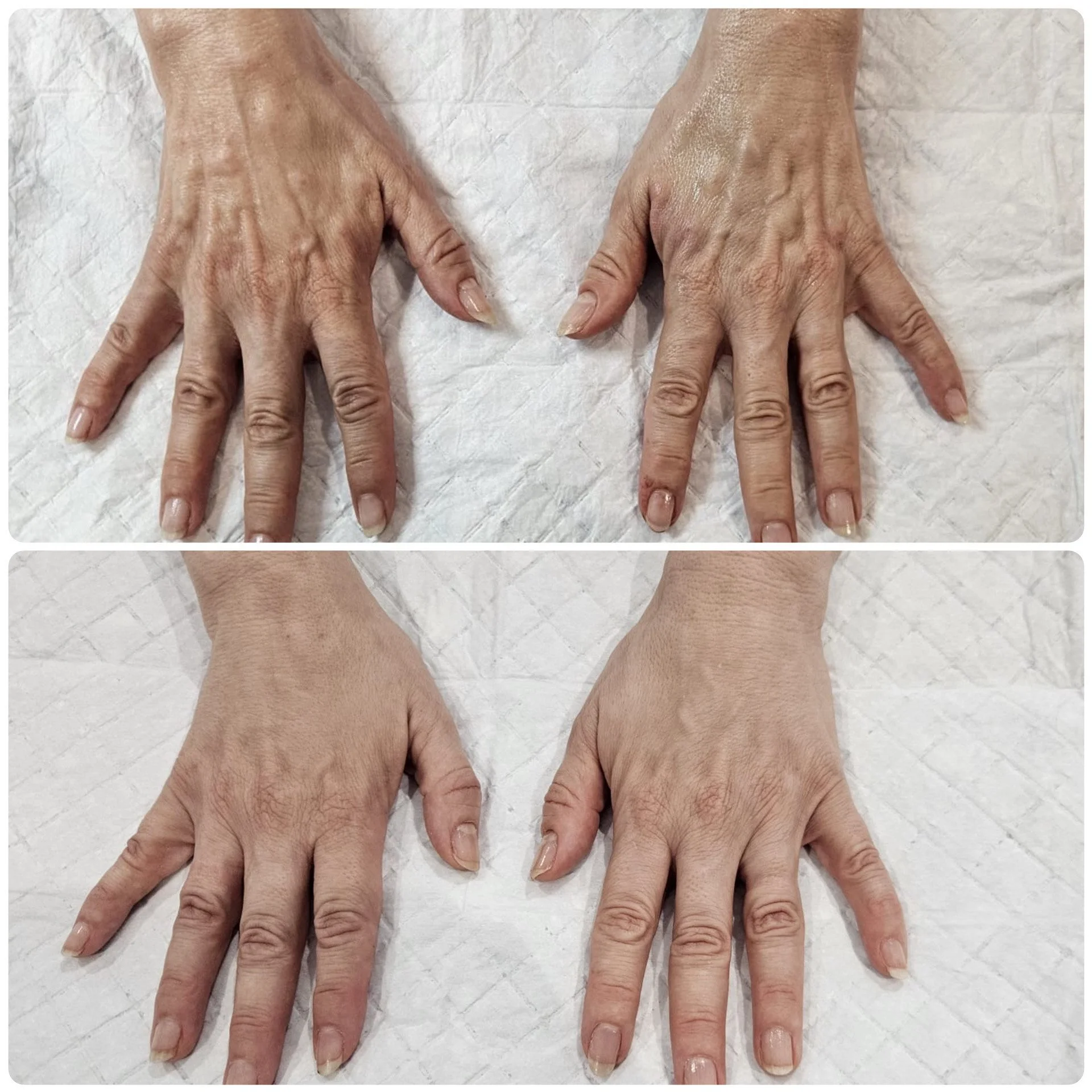 B-FAB® Skin Booster & Dermal Filler