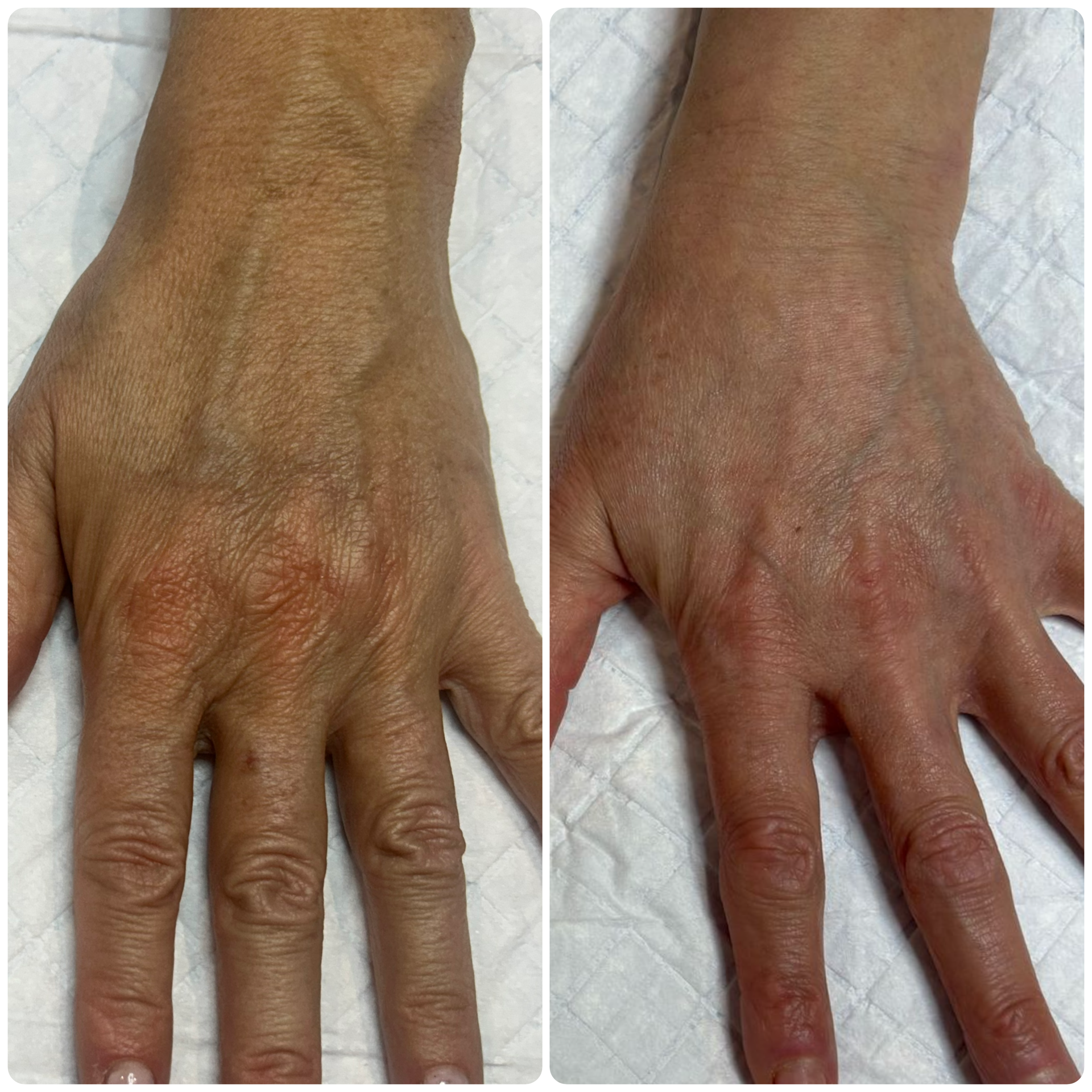 B-FAB® Skin Booster & Dermal Filler