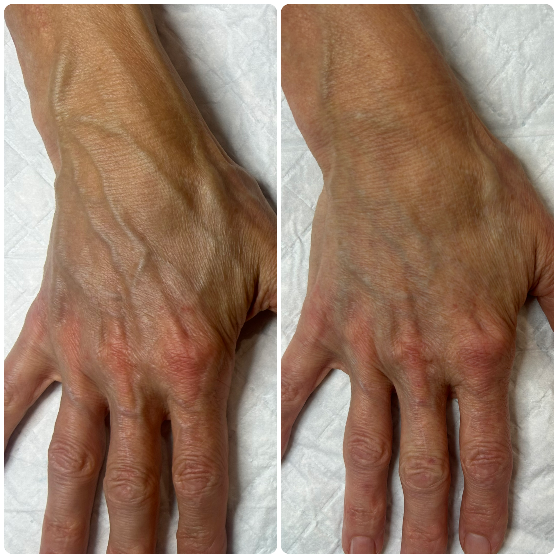 B-FAB®  Skin Boosters & Dermal Filler