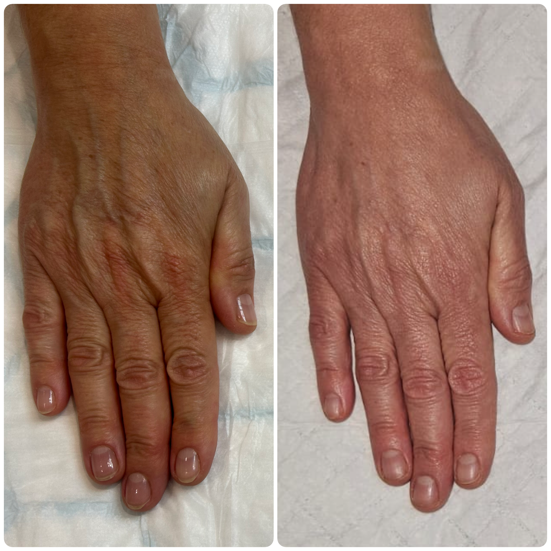 B-PAB®  Skin Boosters & Polynucleotides