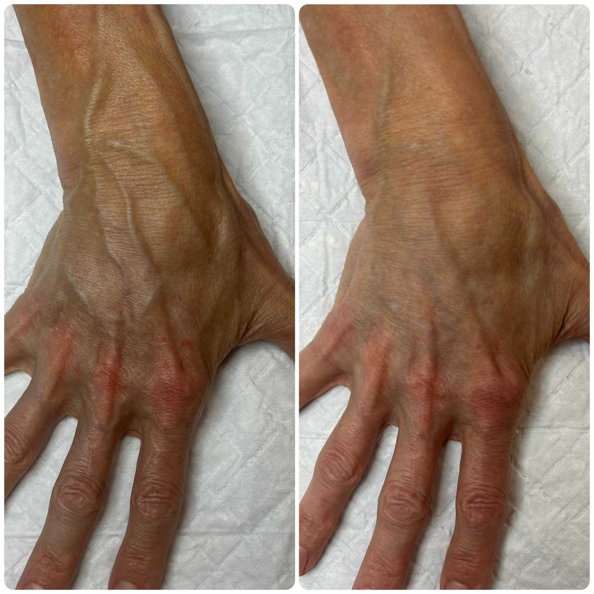 B-FAB®  Skin Boosters & Dermal Filler