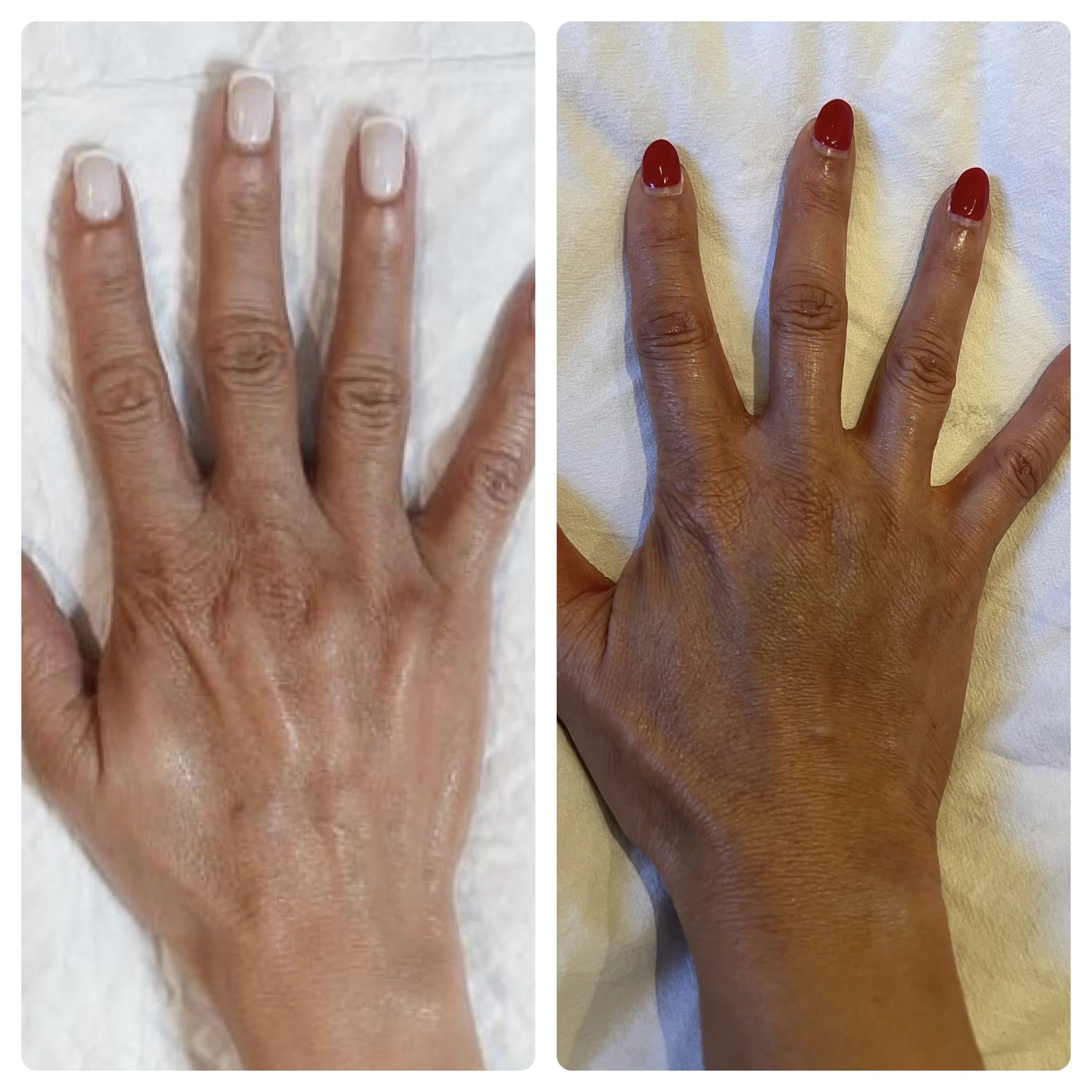 B-FAB® Skin Booster & Dermal Filler