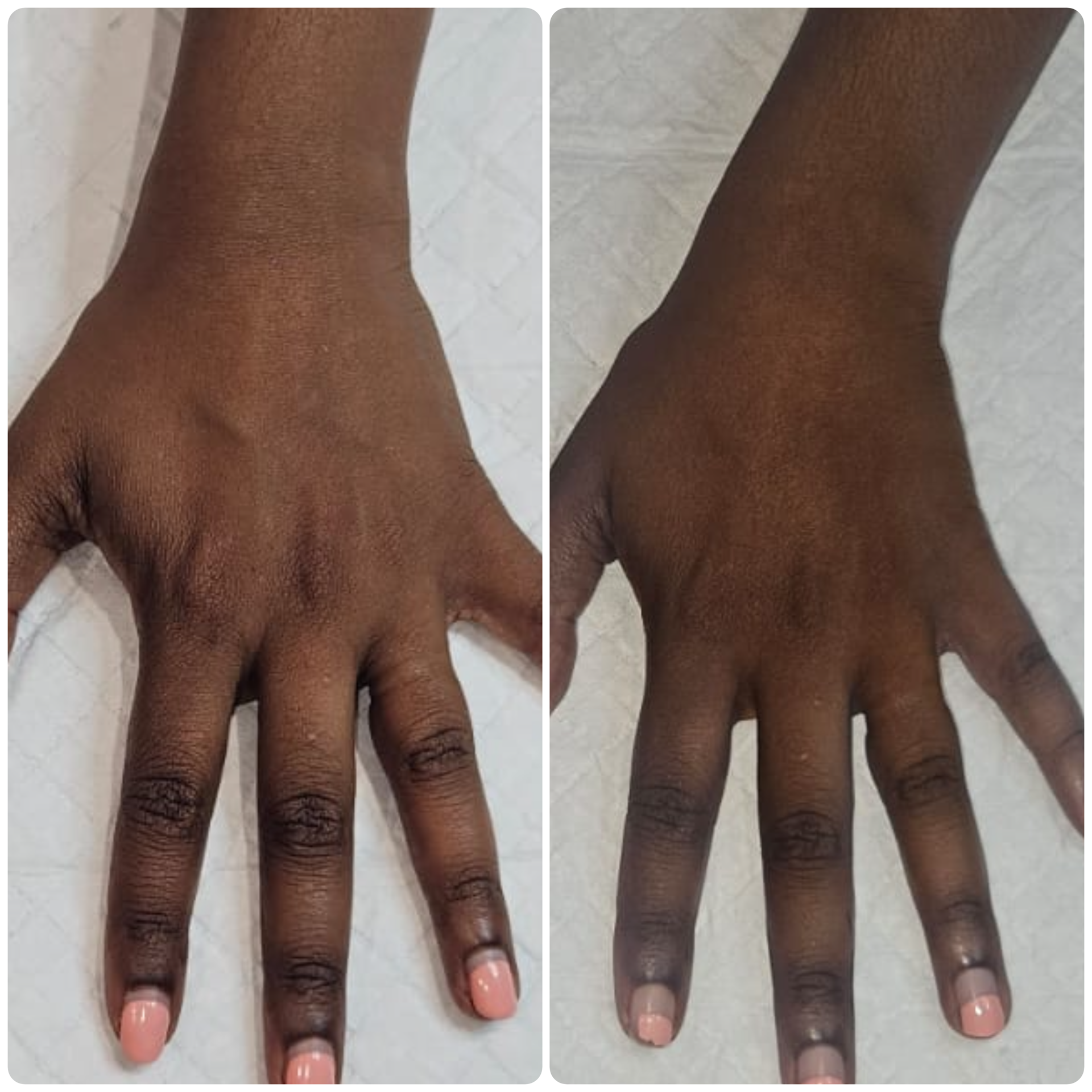 B-PAB® Skin Booster & Polynucleotides